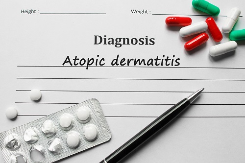 Guideline For Diagnosis And Assessment Of Atopic Dermatitis - Eczema ...