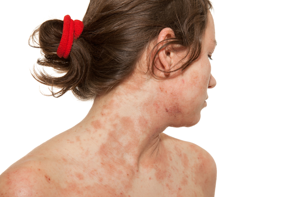 Patient Reported Global Severity Of Atopic Dermatitis Is Valid In Adults Eczema Awareness