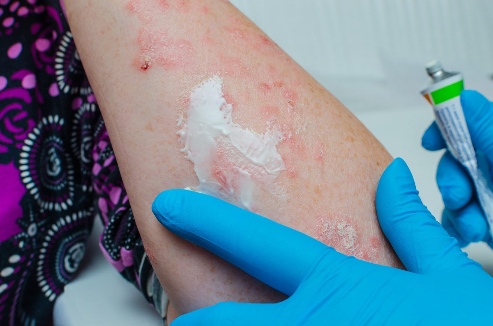 Tapinarof As An Important Advance In Topical Medicine Development For Ad Eczema Awareness