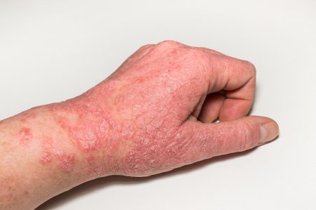 Types and treatments: Atopic dermatitis - Eczema Awareness Monthly - An