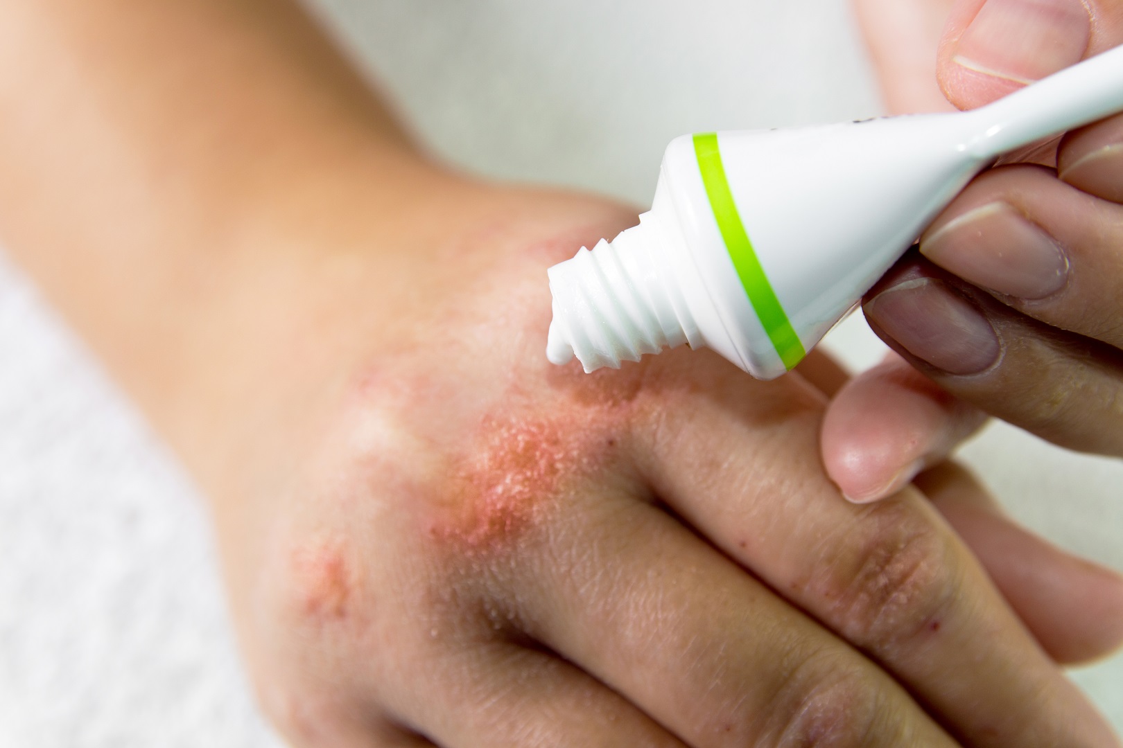 patient-perceptions-of-the-quantity-of-topical-corticosteroids-advised